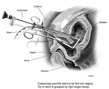 Vesicovaginal fistula -VVF